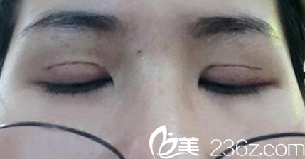 7天拆完线疤痕恢复情况