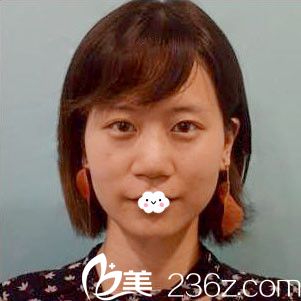 随州奥莱鼻综合隆鼻真人案例 随州奥莱鼻综合隆鼻真人案例