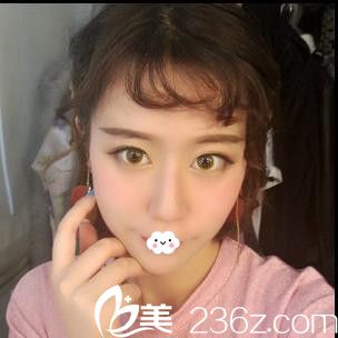 随州隆鼻哪家好?随州奥莱<!--<i data=20240703-sp></i>-->假体隆鼻真人案例 随州隆鼻哪家好?随州奥莱<!--<i data=20240703-sp></i>-->假体隆鼻真人案例