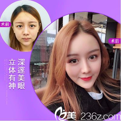 深圳美莱周洪超医生做的双眼皮案例 深圳美莱周洪超医生做的双眼皮案例