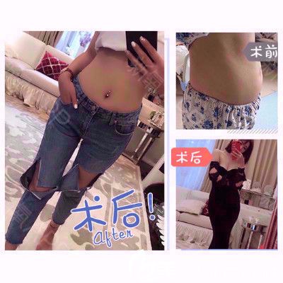 深圳美莱周洪超医生做的腰腹部吸脂案例 深圳美莱周洪超医生做的腰腹部吸脂案例