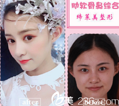 亳州哪家隆鼻好？看缔莱美整形肋软骨鼻综合整形案例