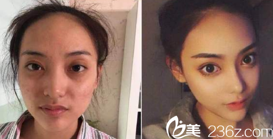 缔美精雕双眼皮+开内眼角+达拉斯鼻综合隆鼻