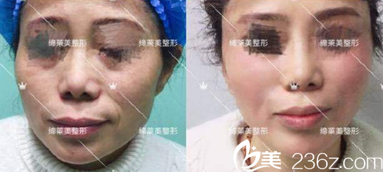 缔美面部童颜术即刻效果对比