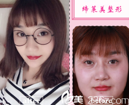 打瘦脸哪家好？亳州缔美瘦脸案例效果图来证明