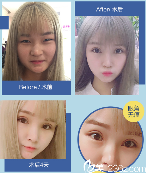 广州美莱曾德渊医生做的双眼皮开眼角案例 广州美莱曾德渊医生做的双眼皮开眼角案例