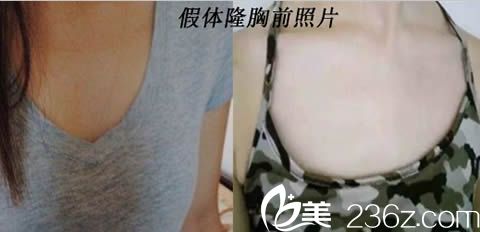 楚雄吴氏嘉美整形假体隆胸前照片 楚雄吴氏嘉美整形假体隆胸前照片