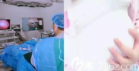 楚雄吴氏嘉美整形医院内窥镜假体隆胸术中图 楚雄吴氏嘉美整形医院内窥镜假体隆胸术中图