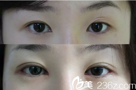 深圳美莱尹度龙做的三眼皮修复案例