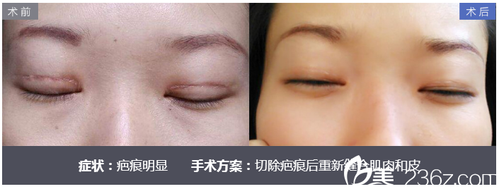 深圳美莱尹度龙的双眼皮疤痕修复案例