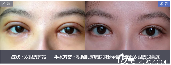 深圳美莱尹度龙做的双眼皮宽变窄修复案例