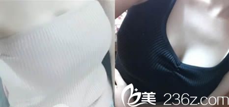 楚雄吴氏嘉美曼托假体隆胸术后15天照 楚雄吴氏嘉美曼托假体隆胸术后15天照