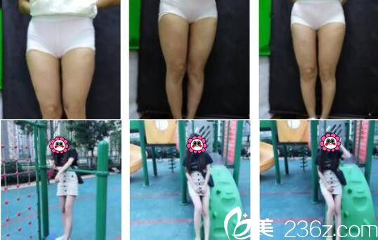 上海艺星大腿吸脂真人案例
