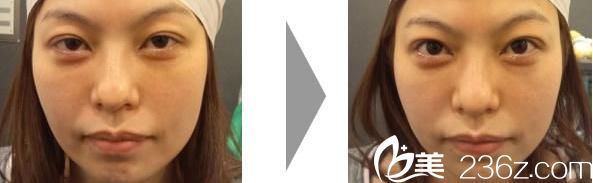 黑眼睛整形 黑眼睛整形