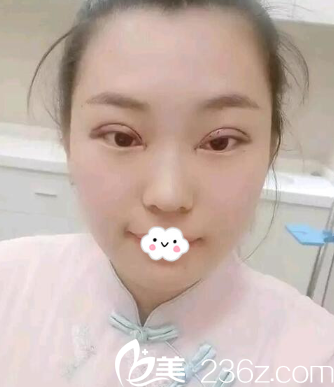 <!--<i data=20240703-sp></i>-->整形怎么样？陈茂年双眼皮<span style=