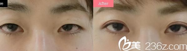 切开法双眼皮 切开法双眼皮