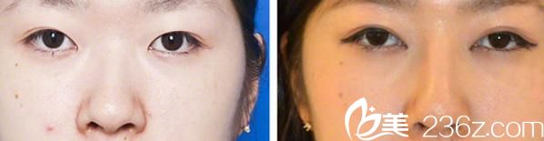 假体隆鼻 假体隆鼻