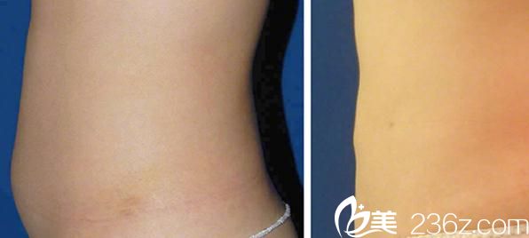 吸脂手术 吸脂手术