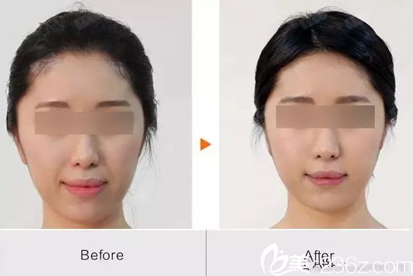 张绍斌自体脂肪填充法令纹案例 张绍斌自体脂肪填充法令纹案例