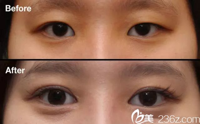 郭帅双眼皮案例