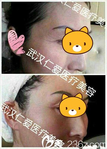 刘莉除皱针案例