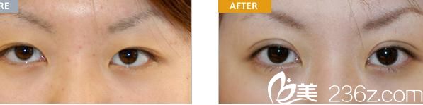切开法双眼皮 切开法双眼皮