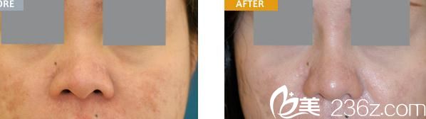 假体隆鼻 假体隆鼻