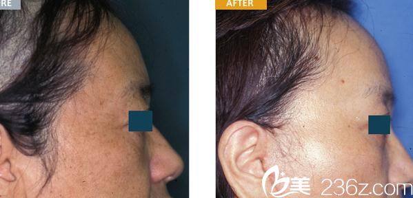 额头提升 额头提升