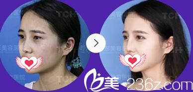 重庆时光整形医院眼综合+鼻综合案例效果 重庆时光整形医院眼综合+鼻综合案例效果