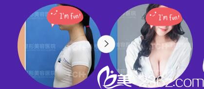 重庆时光整形医院假体隆胸案例 重庆时光整形医院假体隆胸案例