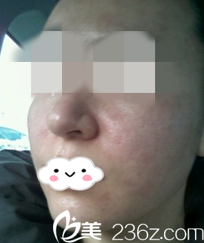 术后即刻的效果