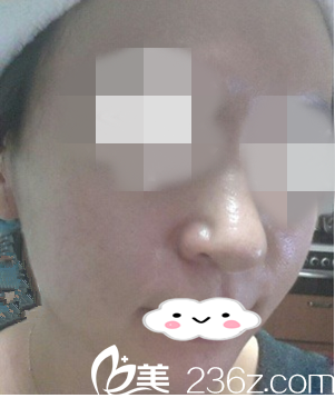 接受光子嫩肤二次治疗的我