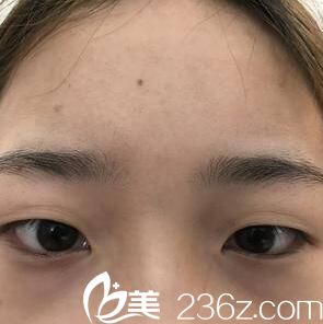 在沈阳割双眼皮术前照 在沈阳割双眼皮术前照