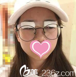 割双眼皮术当天照 割双眼皮术当天照