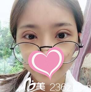 割双眼皮术后第3天效果 割双眼皮术后第3天效果