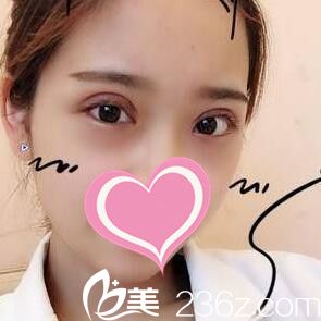 在沈阳安娜宝士丽割双眼皮一周拆线 在沈阳安娜宝士丽割双眼皮一周拆线