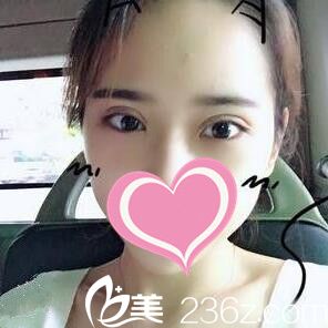 分享10月份我在沈阳安娜宝士丽整形医院割双眼皮术后二十天恢复效果图