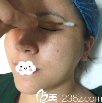 昆明韩辰周杰院长激光祛斑真人案例 昆明韩辰周杰院长激光祛斑真人案例