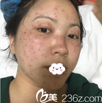 昆明韩辰激光祛斑效果怎么样? 昆明韩辰激光祛斑效果怎么样?