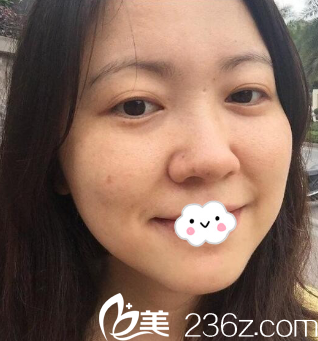 昆明韩辰周杰院长激光祛斑术后15天真实恢复效果 昆明韩辰周杰院长激光祛斑术后15天真实恢复效果