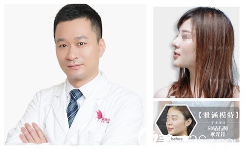 深圳雅涵整形高山院长隆鼻案例 深圳雅涵整形高山院长隆鼻案例