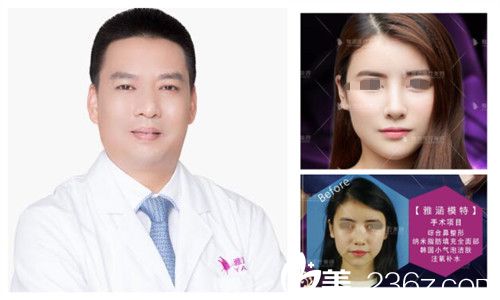 深圳雅涵整形医院夏阳微整形案例 深圳雅涵整形医院夏阳微整形案例