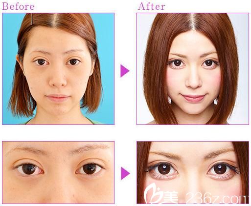 埋线双眼皮手术 埋线双眼皮手术