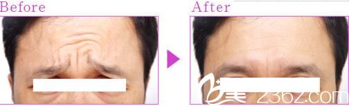 瘦脸除皱眉间注射 瘦脸除皱眉间注射