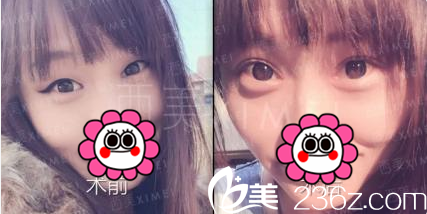 北京西美刘野非手术双眼皮案例