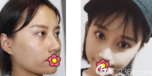 包头丽人自体脂肪面部填充6个月的恢复效果案例