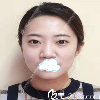 找沈阳百嘉丽汪晓蕾做双眼皮开眼角术前照 找沈阳百嘉丽汪晓蕾做双眼皮开眼角术前照