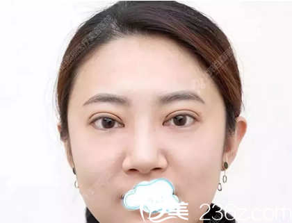 在沈阳做双眼皮+开眼角术后当天照 在沈阳做双眼皮+开眼角术后当天照