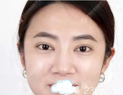 在沈阳百嘉丽做双眼皮开眼角术后1个月效果 在沈阳百嘉丽做双眼皮开眼角术后1个月效果