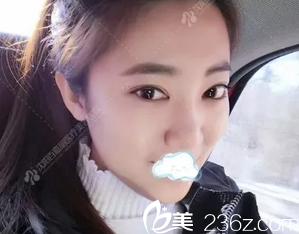 找沈阳百嘉丽汪晓蕾做双眼皮开眼角术后3个月效果 找沈阳百嘉丽汪晓蕾做双眼皮开眼角术后3个月效果